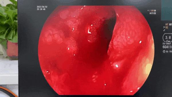 上消化道出血病人抢救,消化道出血病人的护理个案