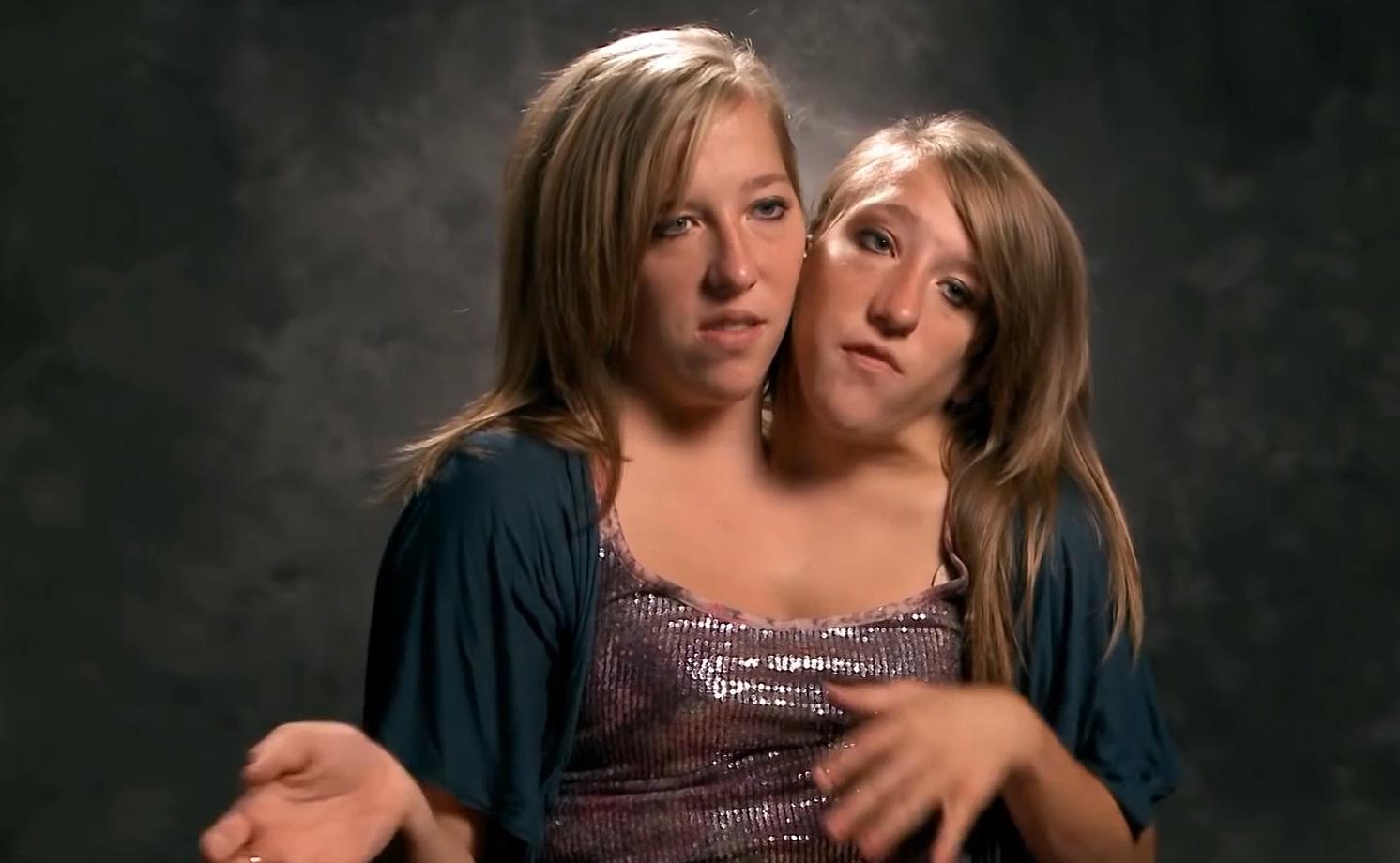 连体姐妹一人结婚现在如何,雌雄连体人结婚怎么办