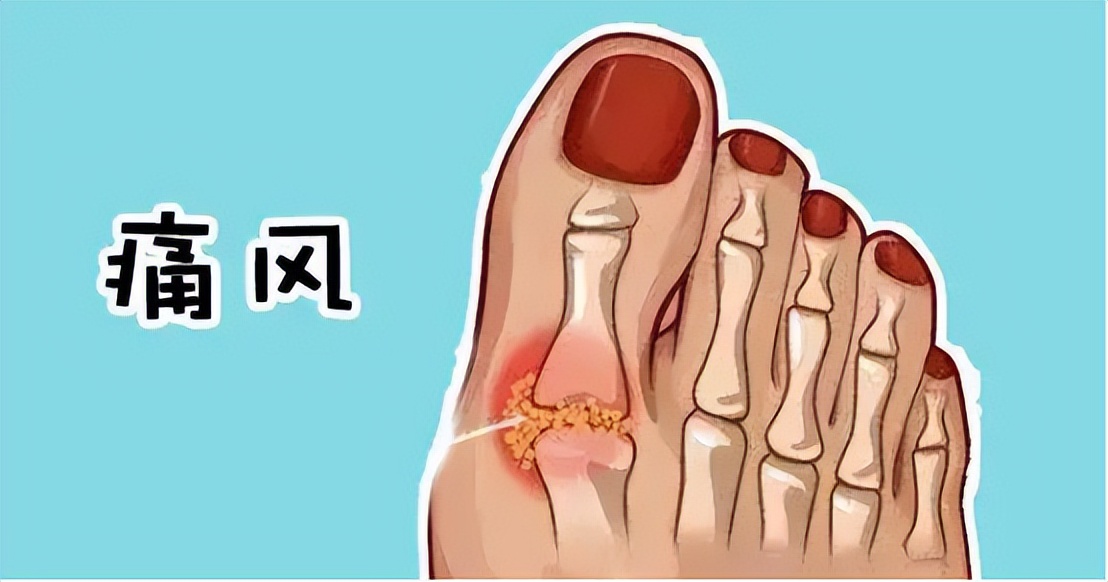 名中医治疗痛风处方,古方通治痛风效果怎么样