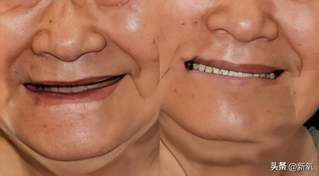 牙齿正畸和骨骼正畸的区别,牙齿正畸和眼轴增长有关系吗