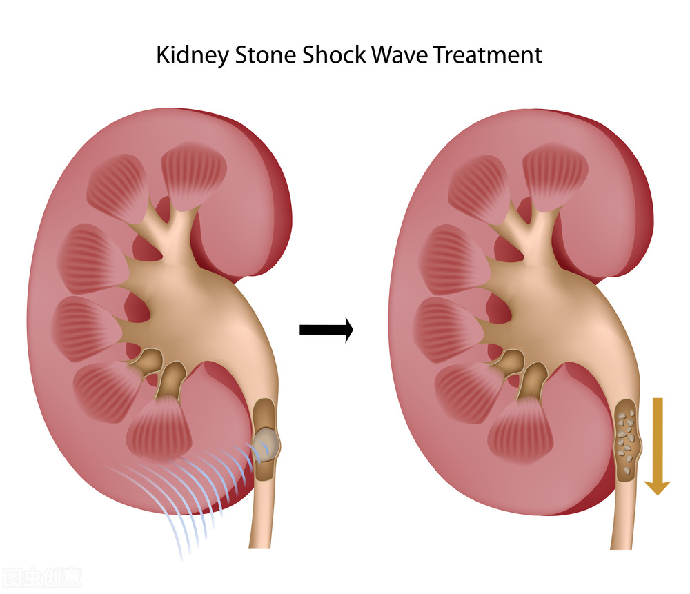 肾结石血尿吃什么药消炎止血,肾结石肾绞痛快速止疼药