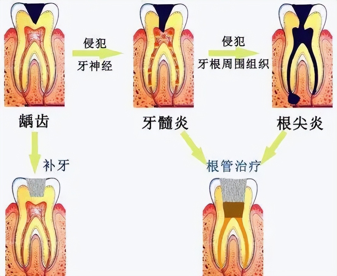 吃冷热都牙痛是哪种牙病,牙痛除了蛀牙还有什么原因
