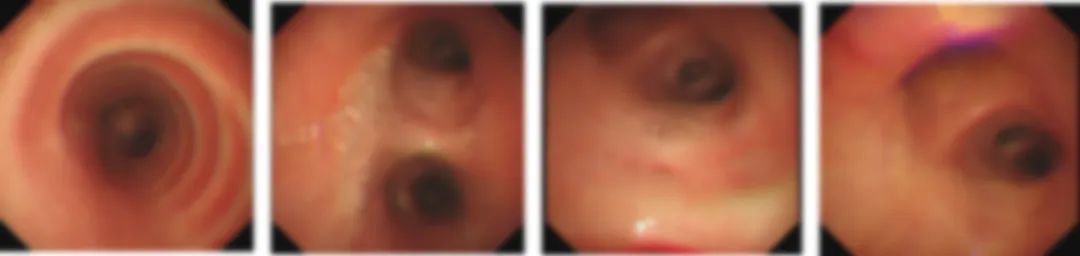 肺部长蘑菇是什么病,肺部有蘑菇结节