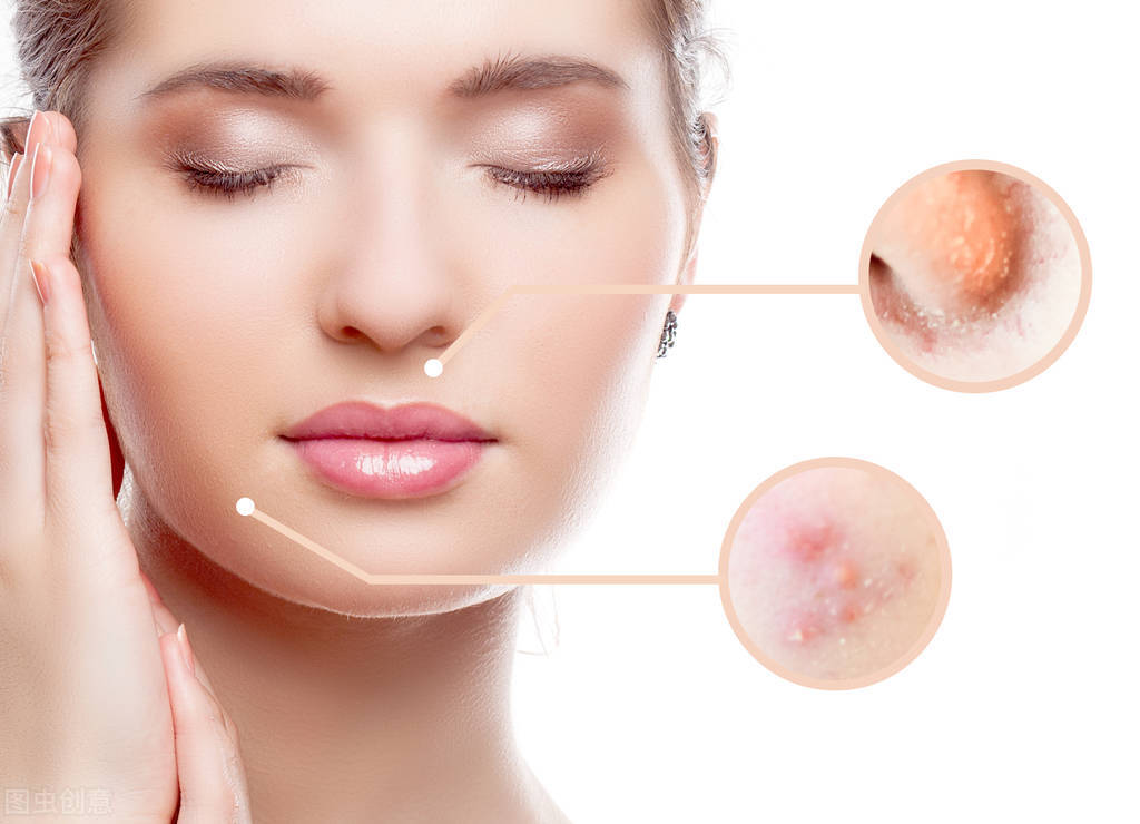 痘痘肌肤是祛痘还是修复屏障,痘痘肌肤全解析让你祛痘不再迷路