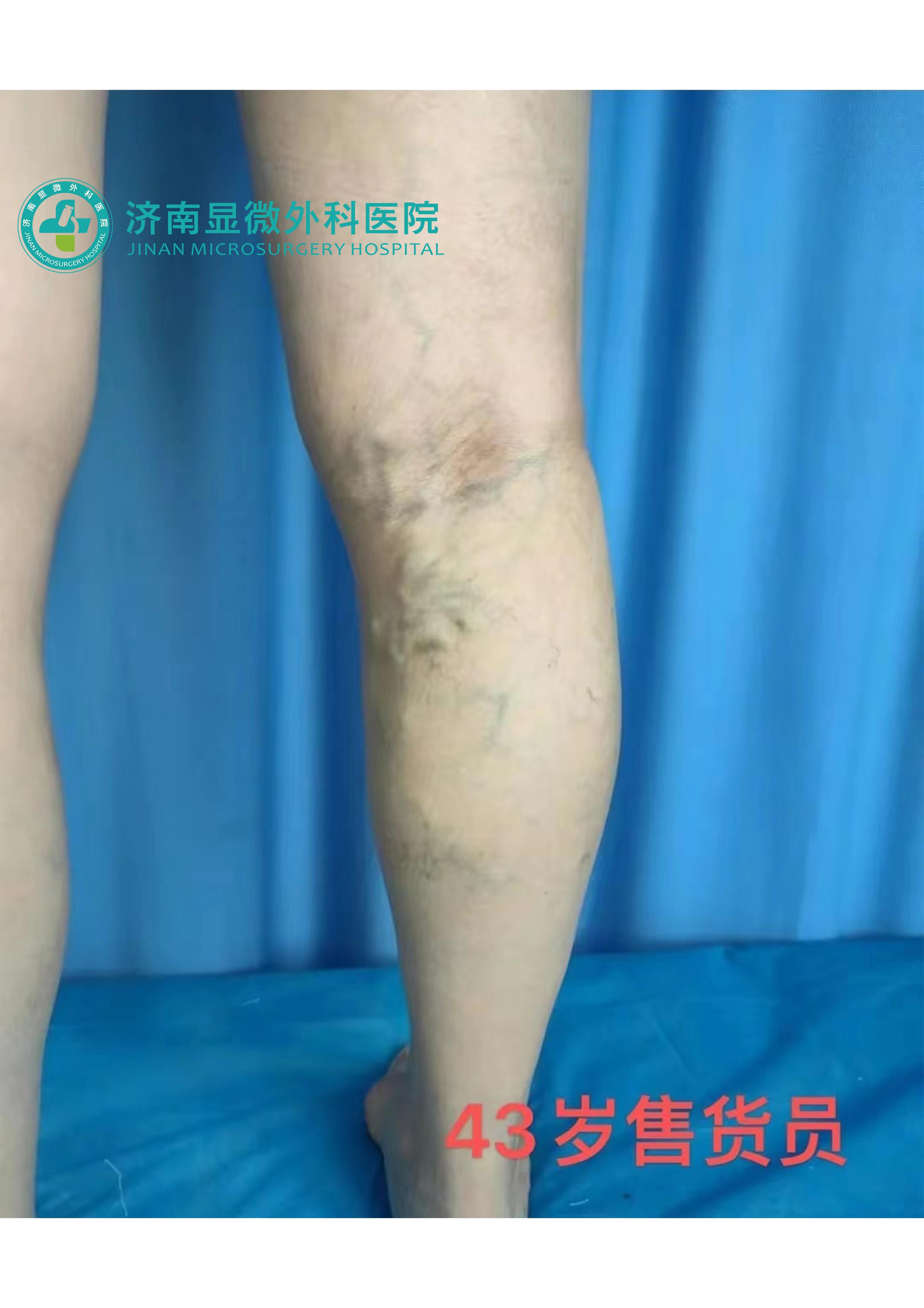 治疗下肢静脉曲张微创疗法是什么,静脉血管曲张手术治疗