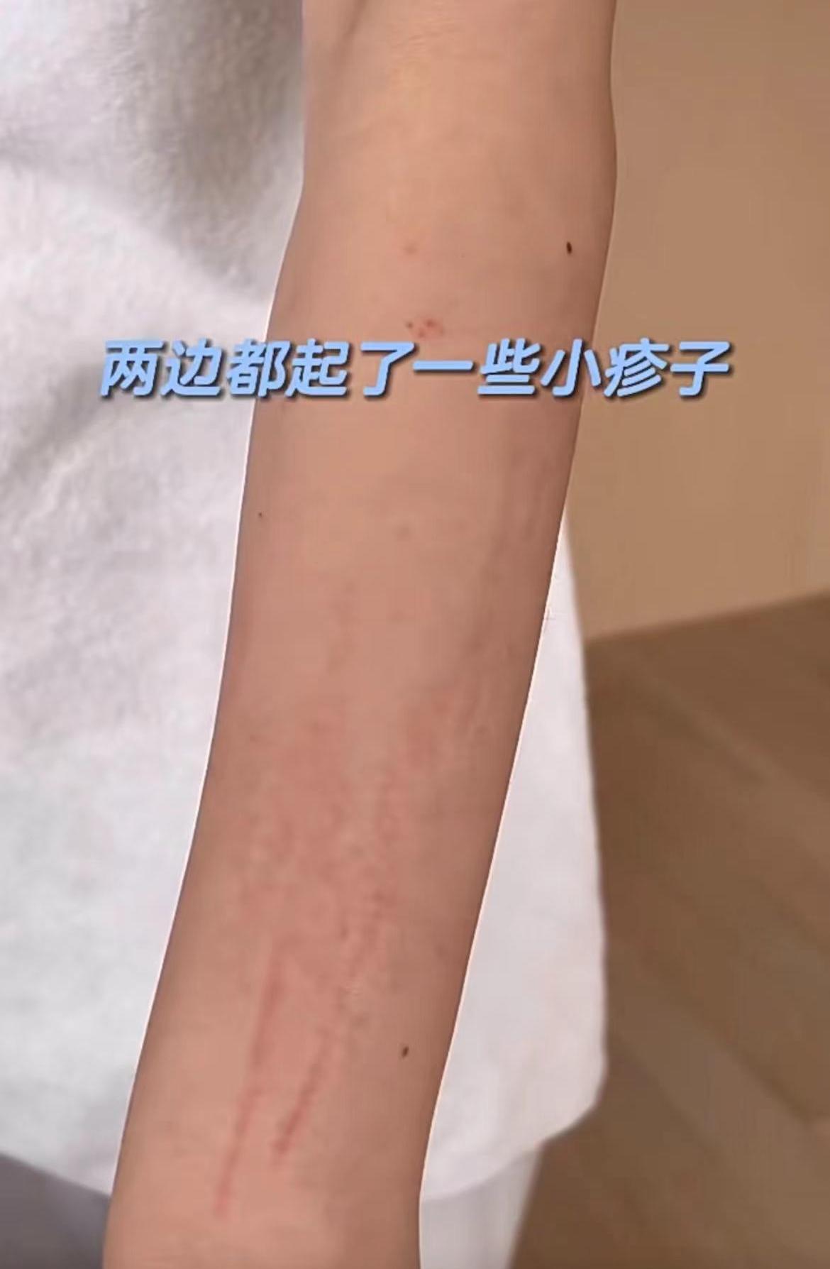 王石爱妻田朴珺裹浴巾出镜，肩膀两大处红肿伤痕，素颜模样变化大