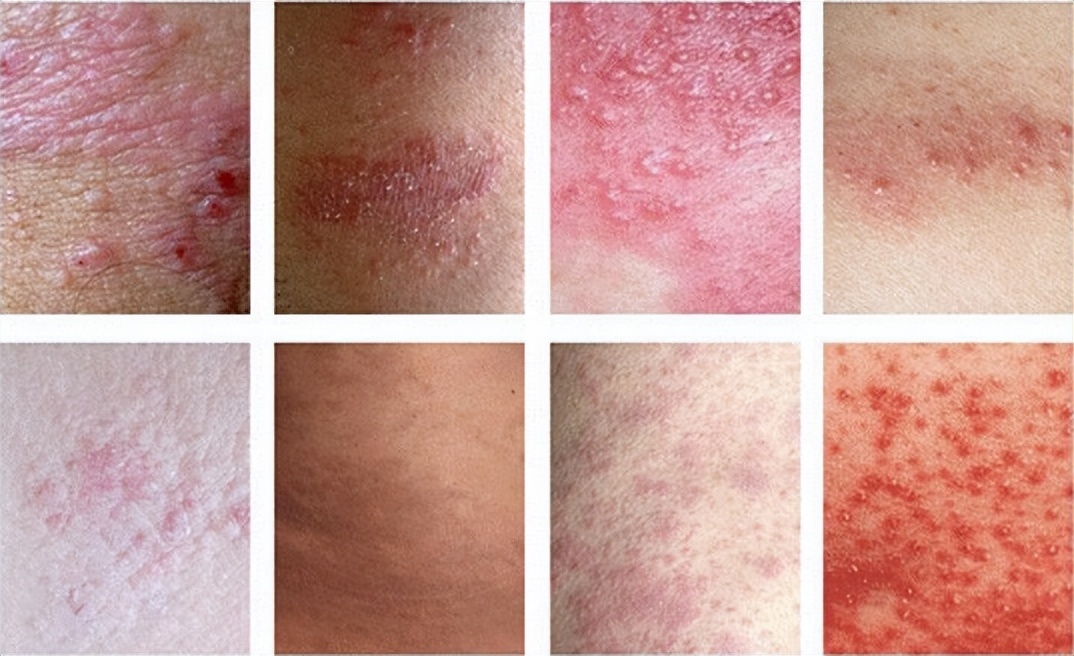 生活中最常见的4种皮肤病,皮肤科可以看多种皮肤病吗