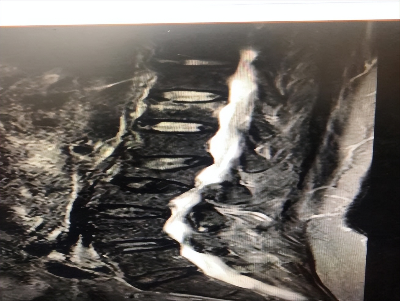 腰扭了和腰闪了是一回事吗,腰扭了怎么处理最好