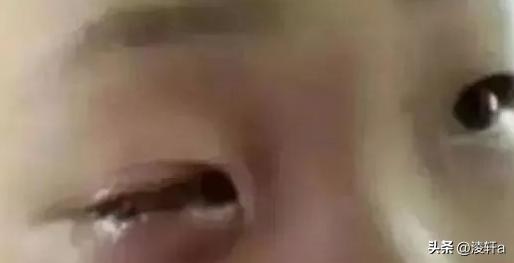 8岁男孩20分钟后眼球融化,男童眼球瞬间被融化