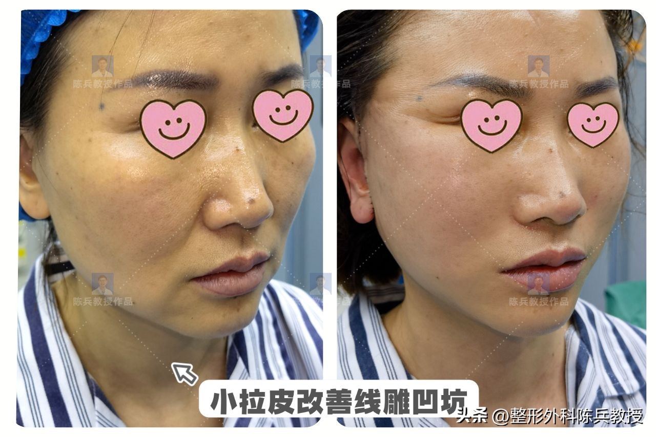 面部皮肤紧致可以做小拉皮吗,面部小拉皮效果怎么样