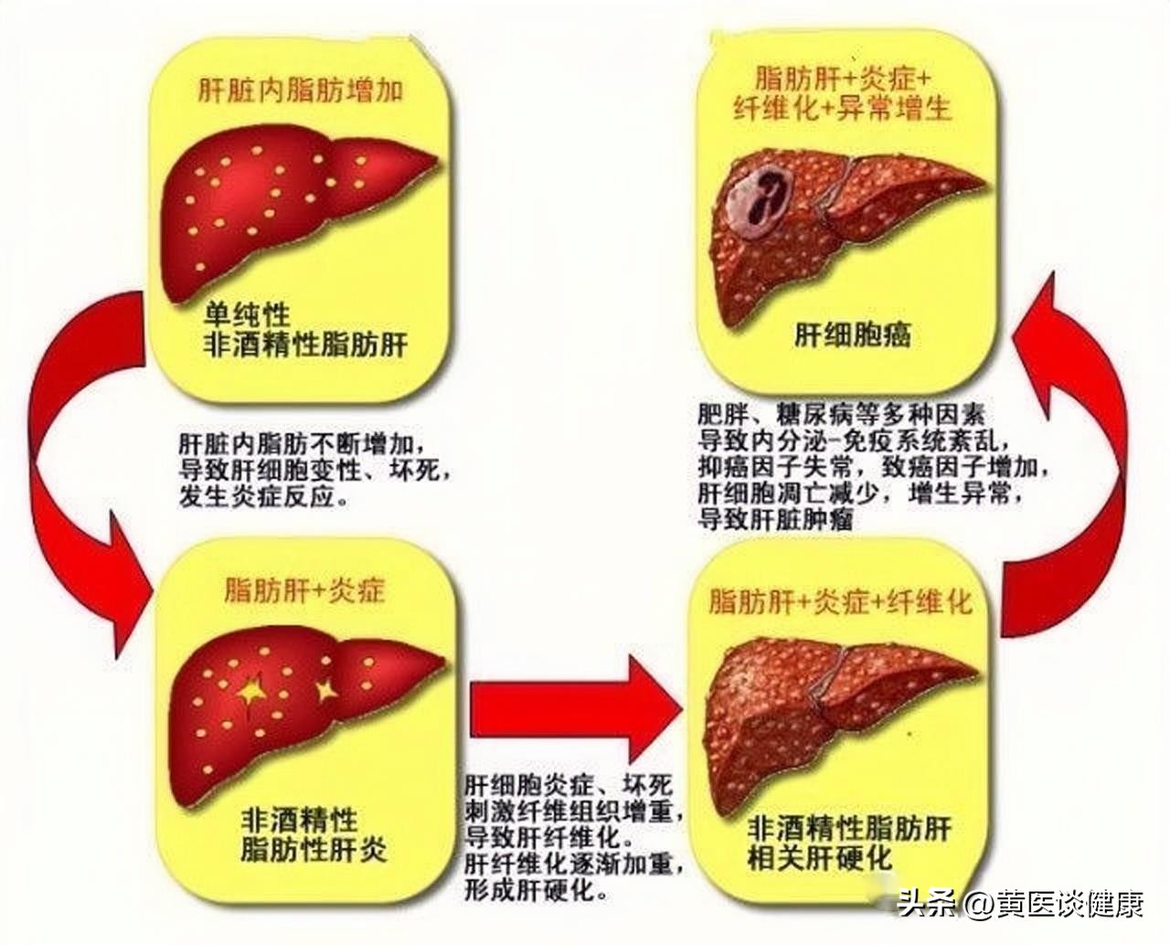乙肝早期肝硬化伴有脂肪肝严重吗,乙肝肝硬化伴有脂肪肝严重吗