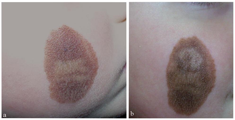 痣变黑变大是癌变了还是癌前病变,痣的病变到癌需要多长时间