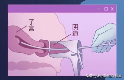 早期人流对子宫的伤害是可逆的吗,人流对女人身体有损伤吗