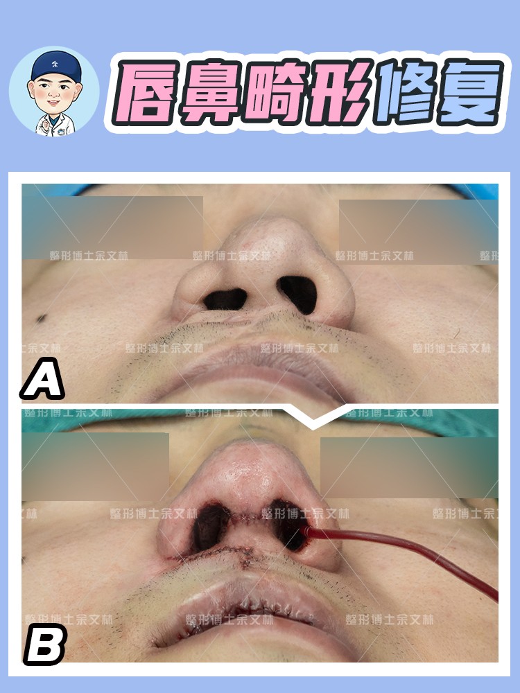 唇裂鼻畸形修复鼻子要多久才定型,唇腭裂鼻畸形怎么修复好