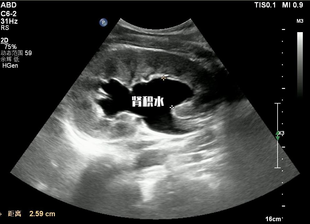 前列腺增生最终会怎么样？会血液透析吗？往往是自己拖出来的