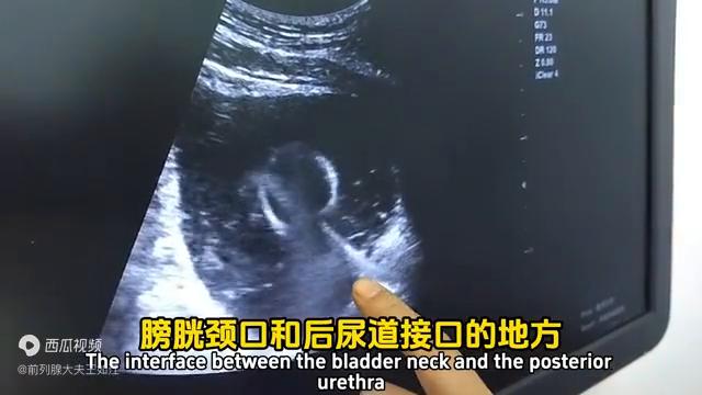 孔医生治疗前列腺炎,经尿道前列腺消融治疗步骤