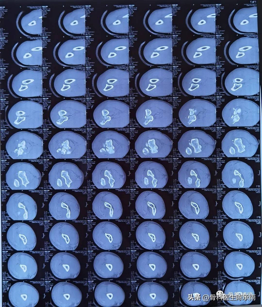 肘关节恐怖三联征最新治疗方法,肘关节恐怖三联征最佳治疗方法