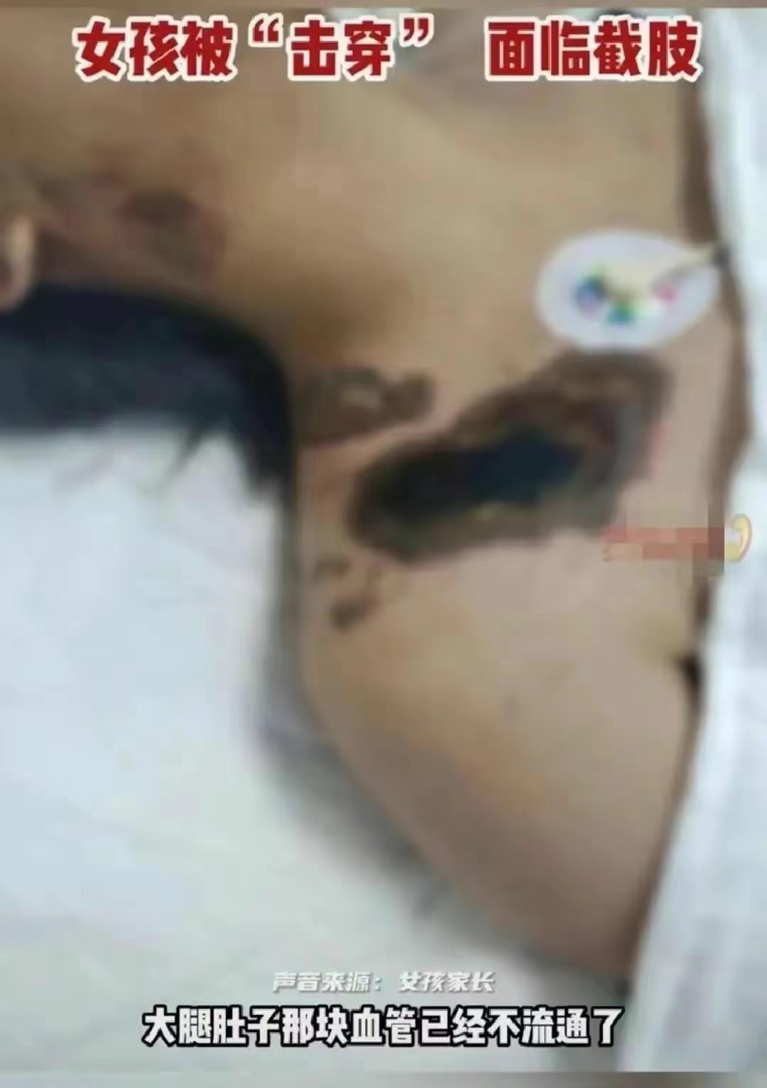 被电击女孩因脏器受损面临截肢,女孩充电时玩手机被电击面临截肢