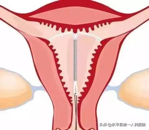 绝经后，你取环了吗？