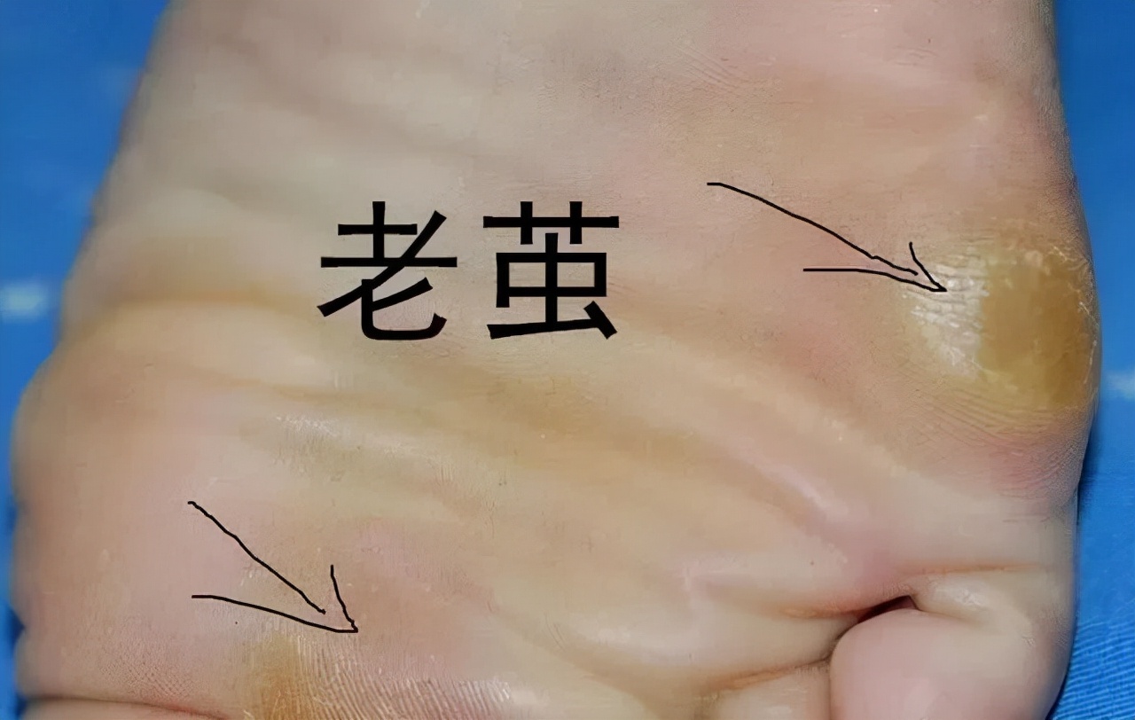 前脚掌长鸡眼有什么治疗方法,脚趾头长鸡眼如何快速治疗