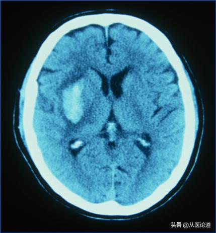 皮肤紫癜血小板减少是什么病,皮肤性紫癜斑块变大