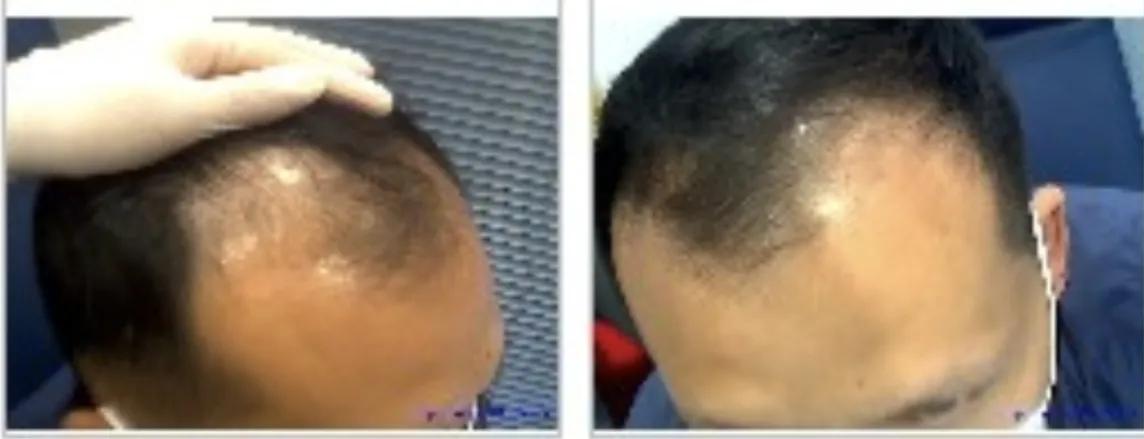 男士植发过来人真实感受,16000字讲述植发真实感受