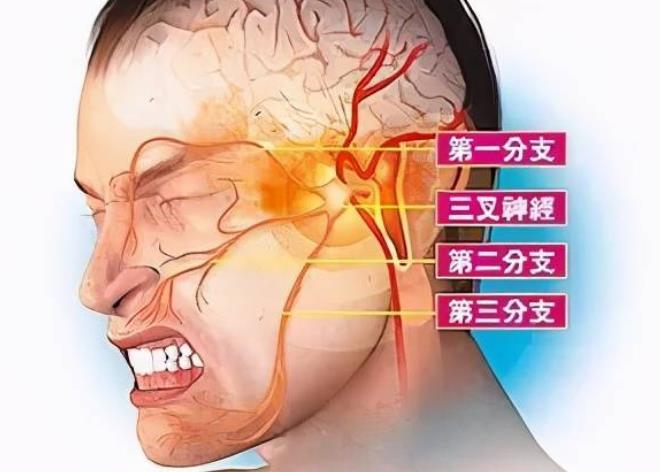 中医解决紧张头痛,中医治疗紧张性头痛