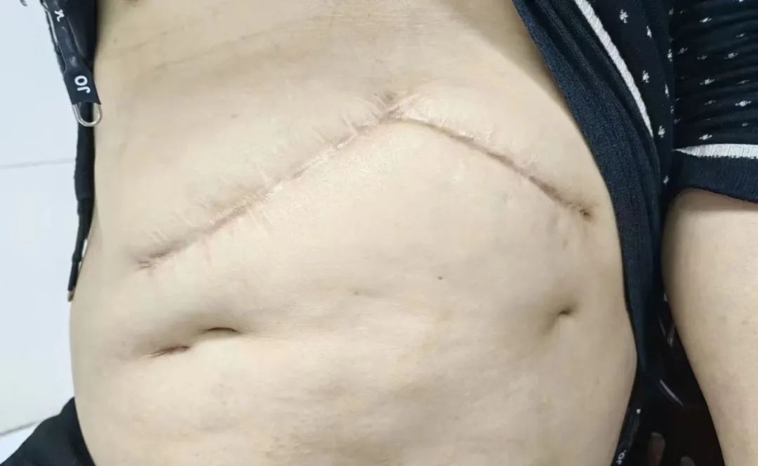 肝内胆管结石微创取石恢复快吗,一男子从胆囊取出几百个结石