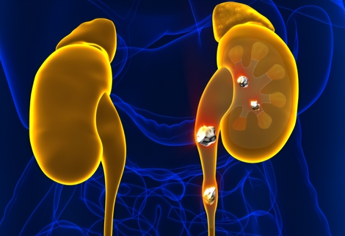 尿液柠檬黄是什么原因引起的,尿液黄泡沫多是什么原因