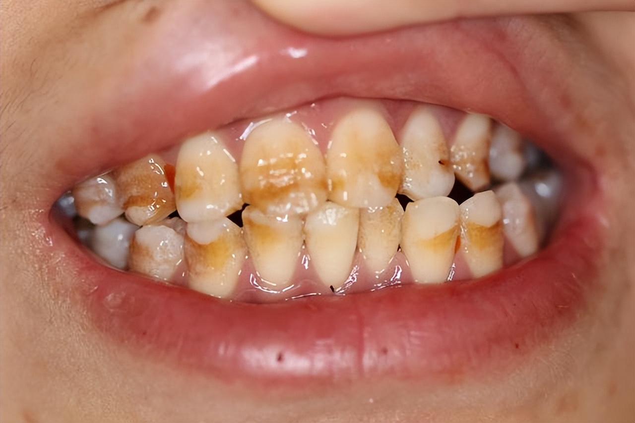 牙齿发黄牙缝大怎么去除,牙齿表面发黑如何处理呢