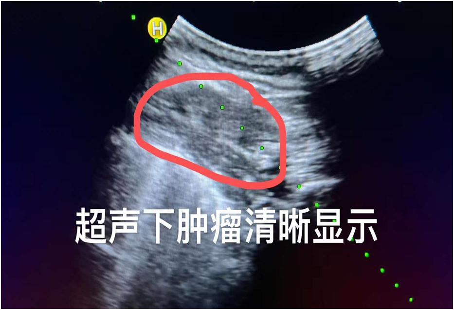 癌疼痛难忍,癌痛受不了热敷好多了