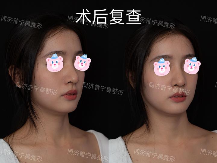 有驼峰的鼻子一定得磨吗,有驼峰的鼻子