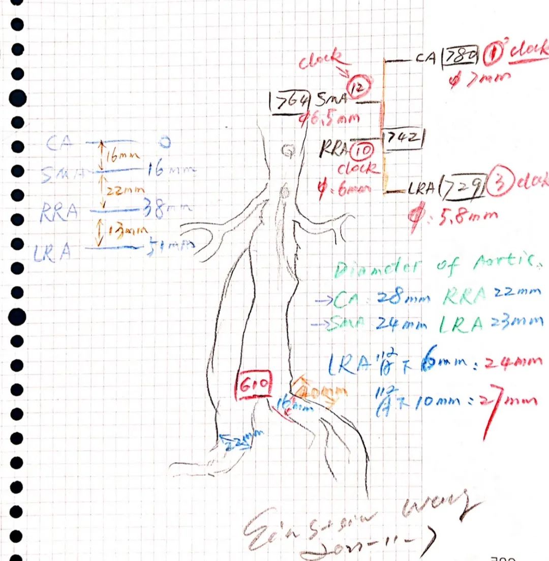 医学专家巧变“工艺师”，妙手缝制支架成功拆除主动脉“*弹炸**”