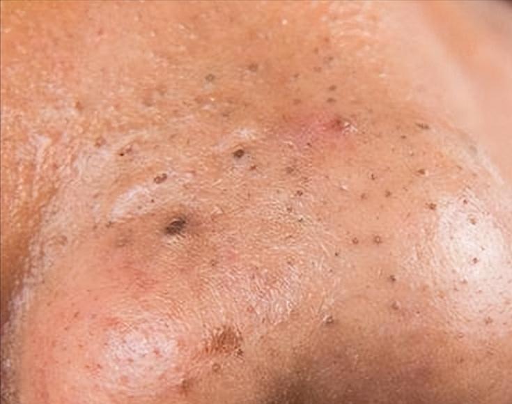 鼻子黑头里挤出的白色油脂怎么办,鼻子上有硬硬的黑头怎么办