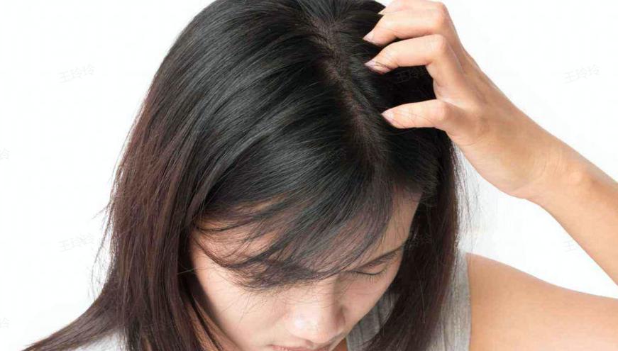 头痒头屑多掉发严重小妙招,治疗头屑头痒脱发的小妙招