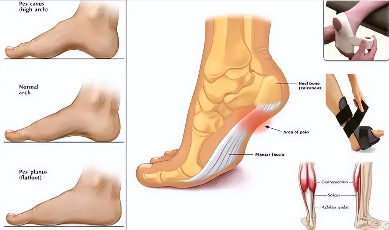 怎么缓解足底筋膜炎的疼痛,筋膜炎患者痛苦