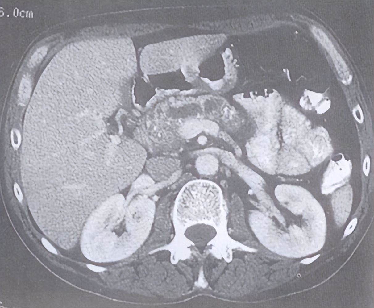 科普不可忽视的胆囊结石,胆管结石科普视频