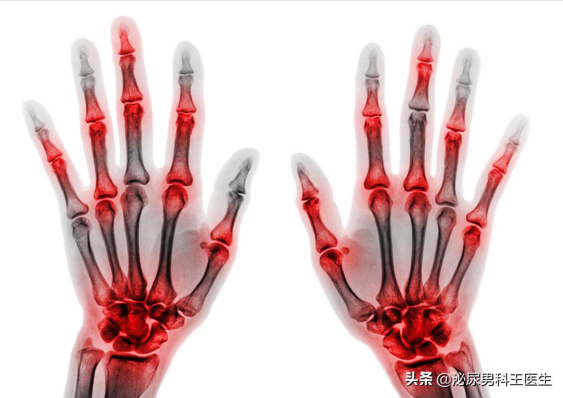 尿酸高如何让尿酸排出体外,尿酸高如何让尿酸排出