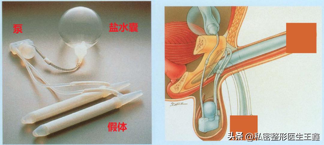 阴茎假体三件套植入手术，不是你想做就能做