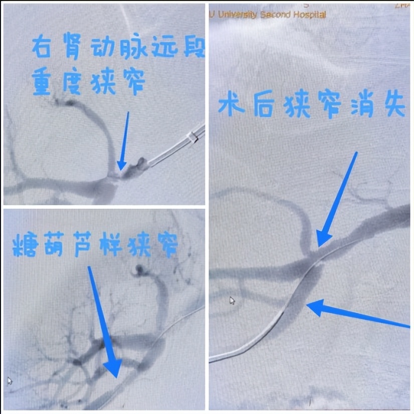 关注青年高血压关注肾动脉狭窄——兰大二院西固医院神经外科成功完成经皮肾动脉狭窄球囊扩张成形术