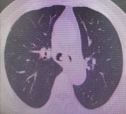 哈医大一院气管镜,哈医大群力呼吸内科