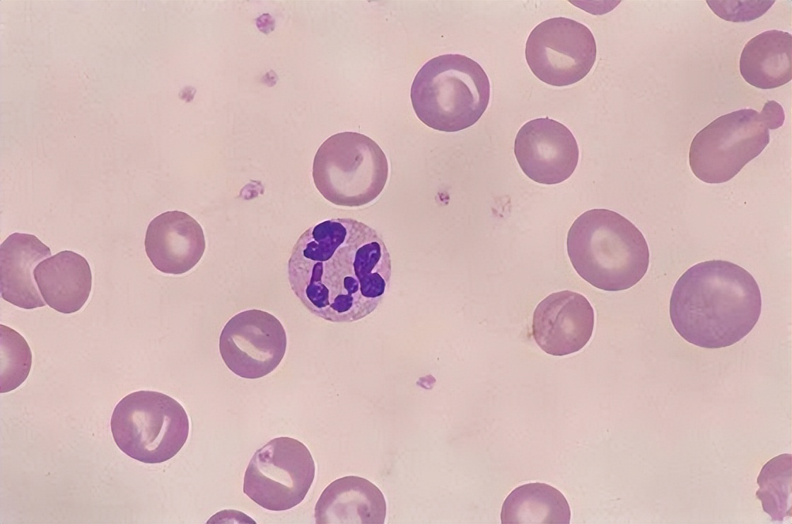 血常规四个指标升高需要注意什么,血常规检查之后才看哪三项