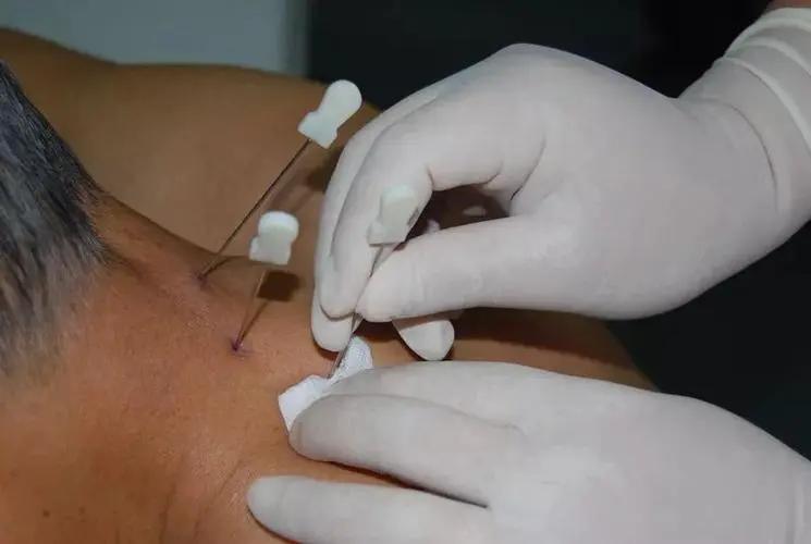 中医认为肛门瘙痒症的发病原因是什么？有何治疗建议？