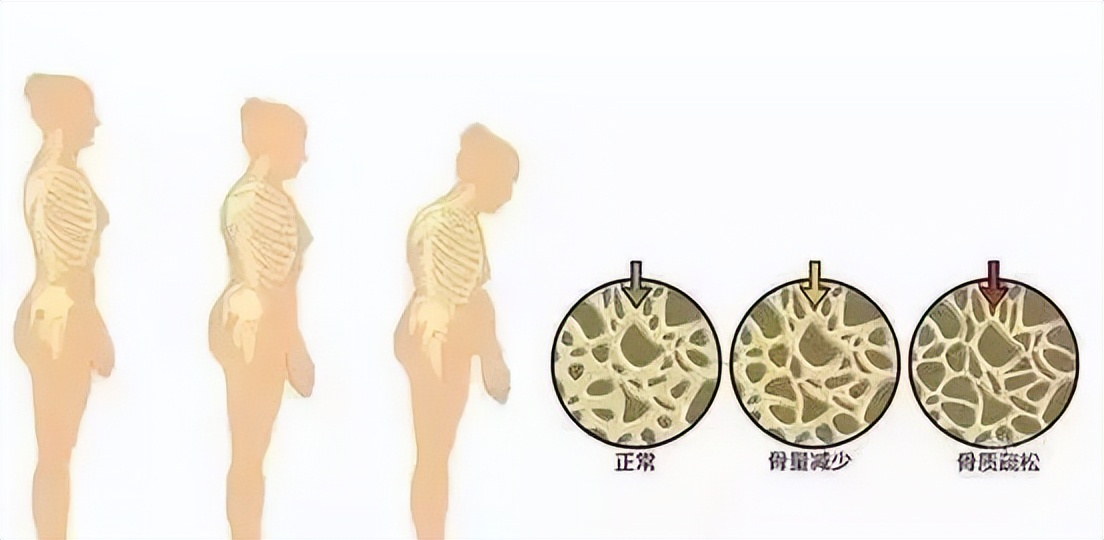中年人钙流失严重什么原因,骨骼钙流失原因
