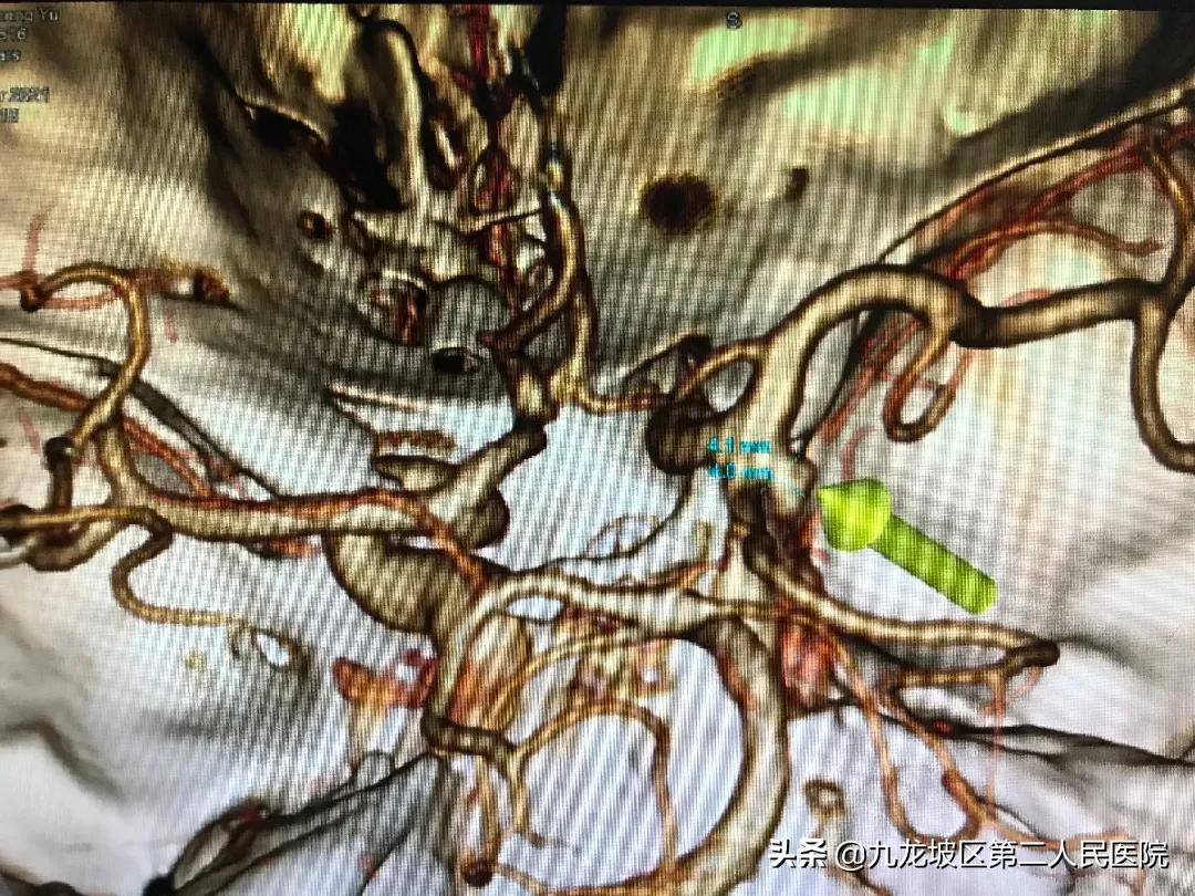 动脉瘤夹闭术是开颅手术还是微创,大脑里面长了一个囊肿扩散到肺上