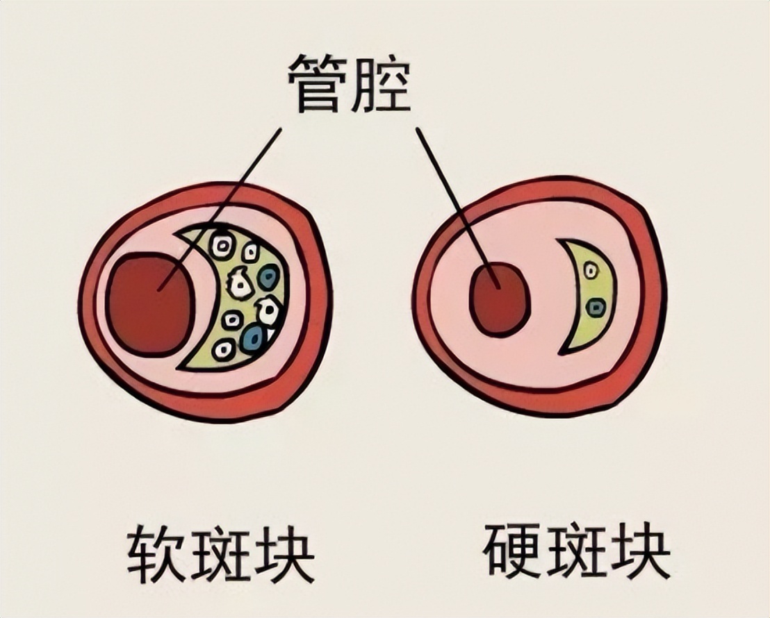 冠心病诊断预测模型,建模预测冠心病