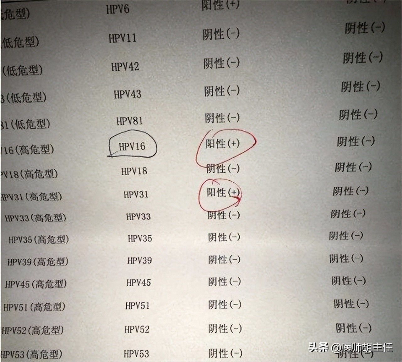 30岁腿痛查出宫颈癌案例,宫颈癌晚期腿上4个信号提示