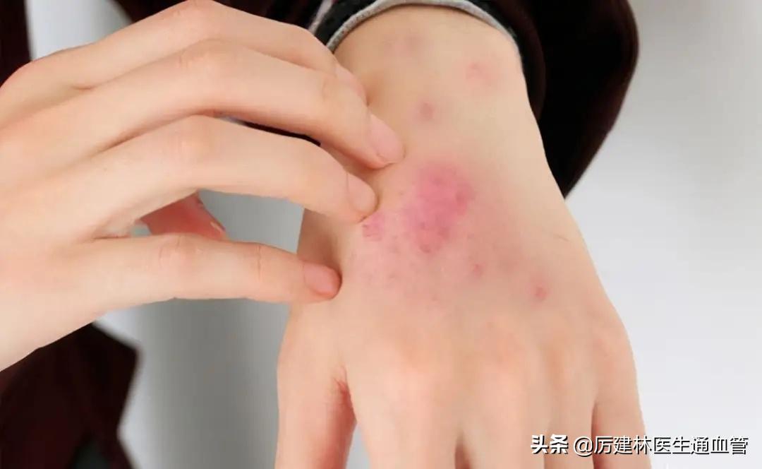 红霉素眼膏和红霉素软膏区别在哪,红霉素软膏和红霉素眼膏有啥区别