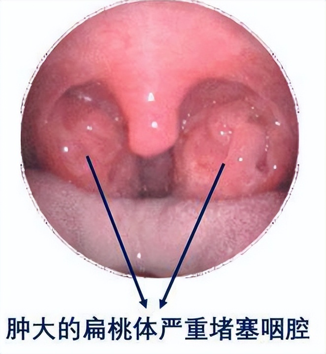 孩子睡觉张口呼吸但是不打鼾,2岁多小宝总爱张嘴睡觉怎么办