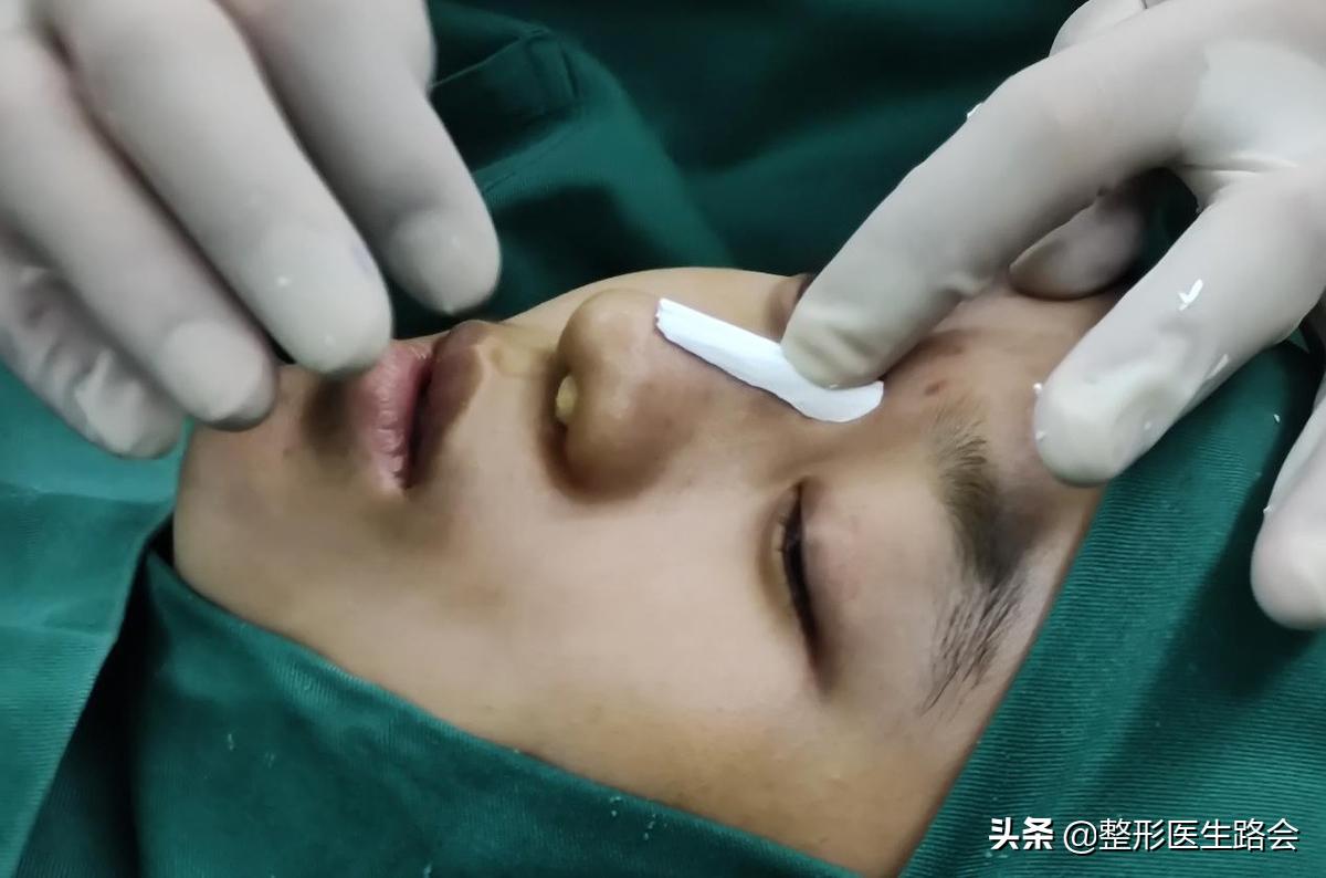 全脸整形记录恢复过程,女孩整形全过程